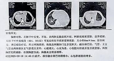 从“被判生存期10天”到身体完全康复｜套细胞淋巴瘤患者重获新生